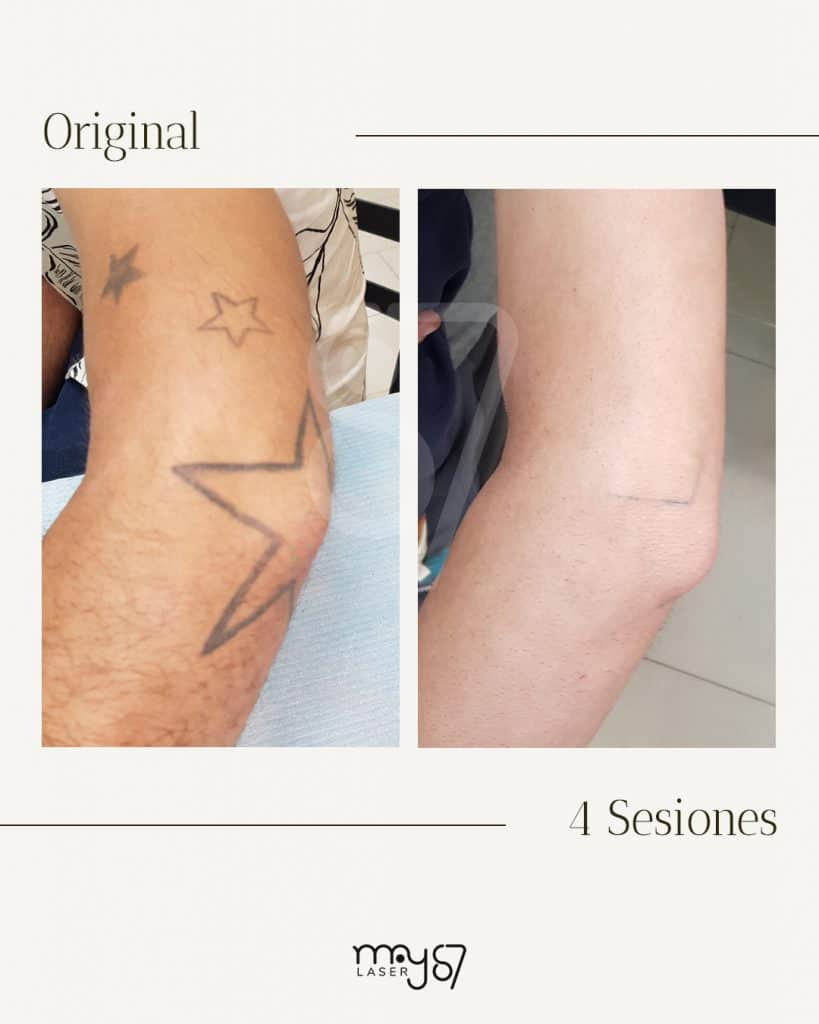 tatuaje de estrella eliminado con nuestros tratamiento laser para elmininar tatuajes