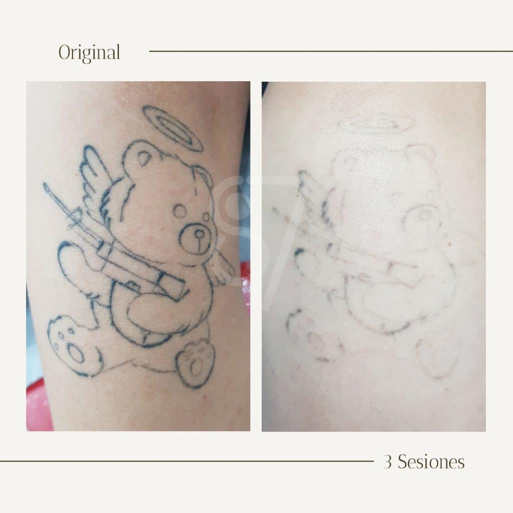 eliminacion de tatuajes dos sesiones con laser