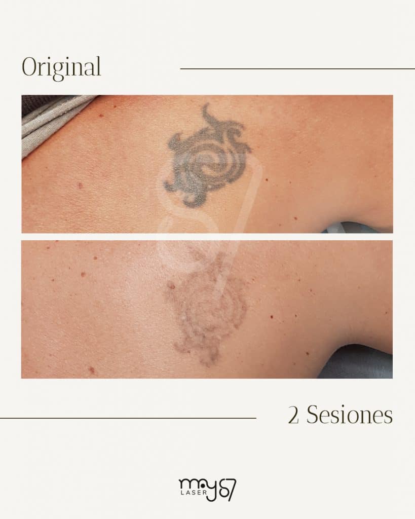 eliminacion de tatuajes parcial con dos sesiones de laser