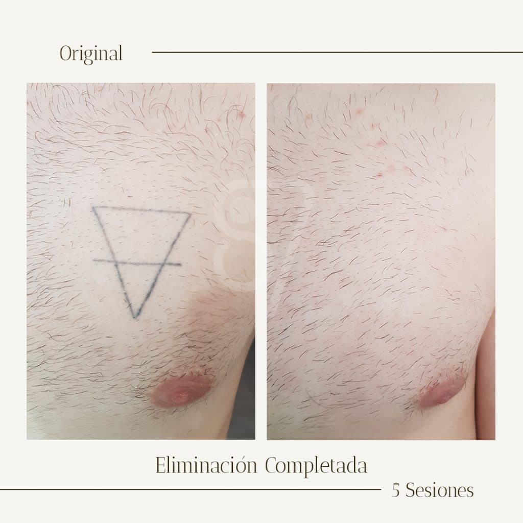 eliminacion de tatuaje completada con el tratamiento laser. antes y despues