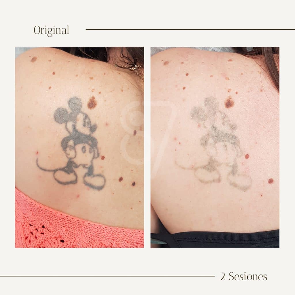 tatuaje micki mous para eliminar con nuestro laser