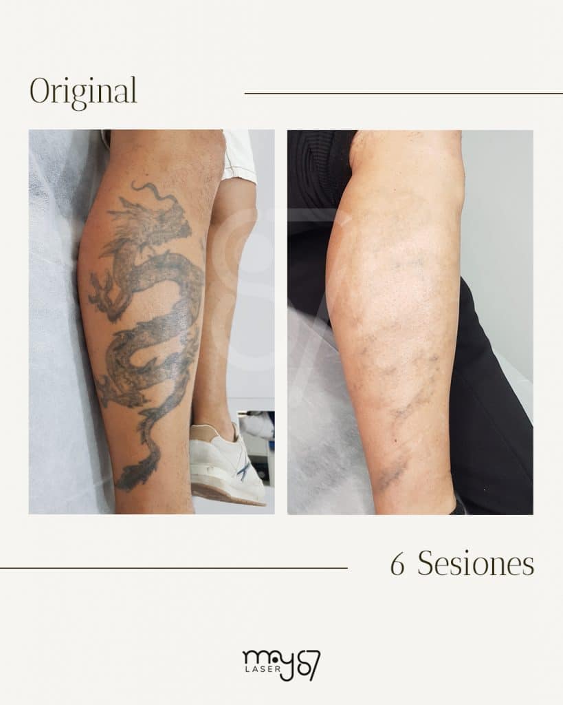 seis sesiones de tratameinto laser, eliminacion de tatuaje casi completada