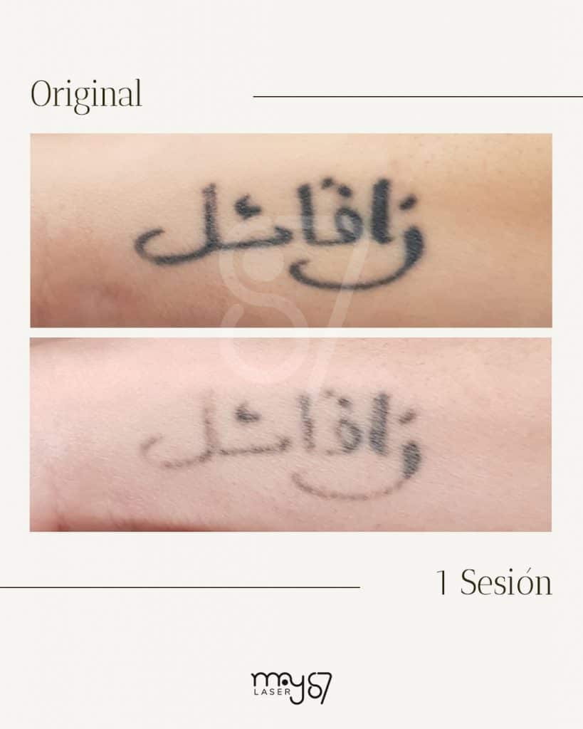 eliminacion de letras arabes tatuadas. 1 sola sesion y se ha eliminado parcialmente