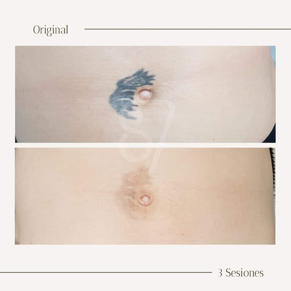 eliminacion de tatuaje en el ombligo con laser