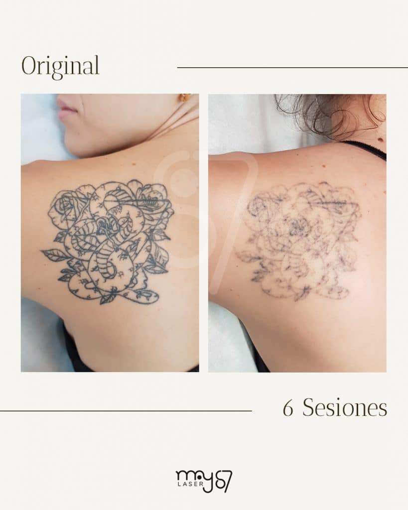 antes y despues del tratamiento para eliminar tatuaje en la espalda