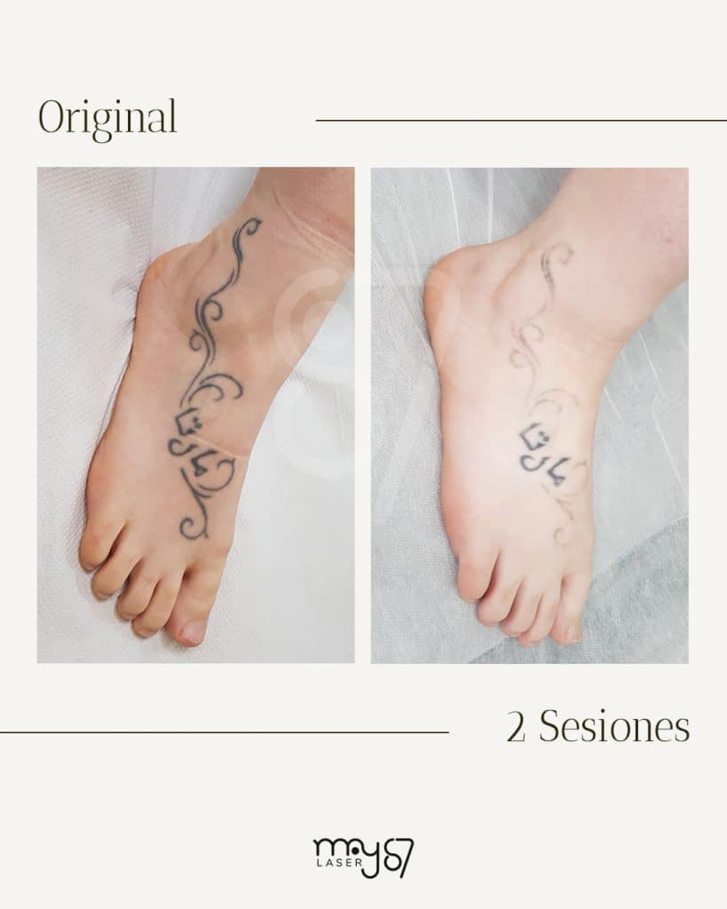 antes y despues del tratamiento laser para eliminar los tatuajes del pie