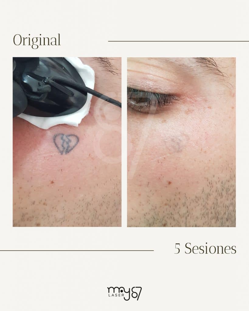 antes y despues de la sesiones para eliminar microblanding o micropigmentacion con tratamiento laser