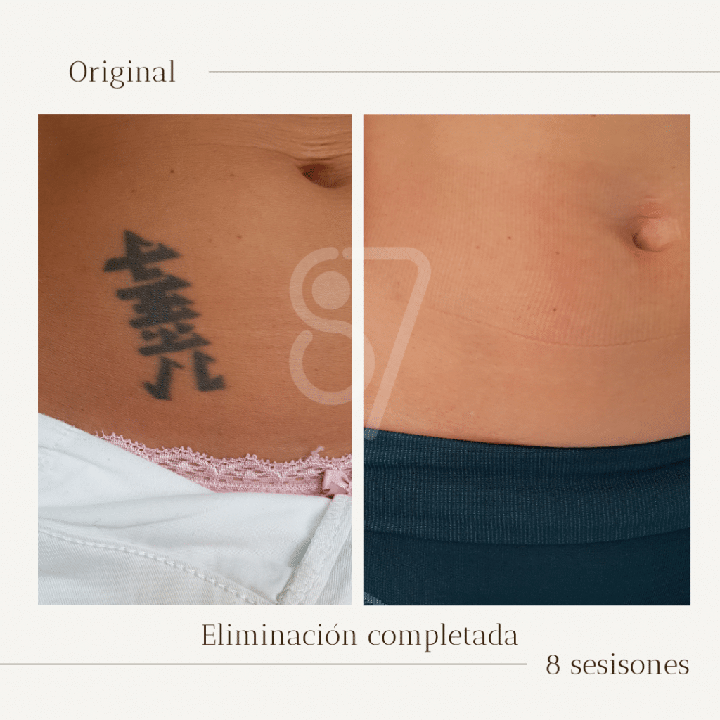 antes y despues de la eliminacion del tatuaje con laser de letras chinas