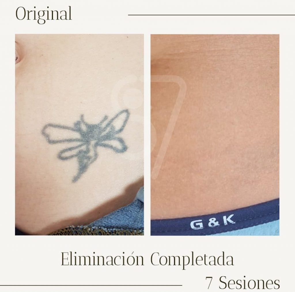 eliminacion de tatuajes completada con el tratameinto laser. antes y despues