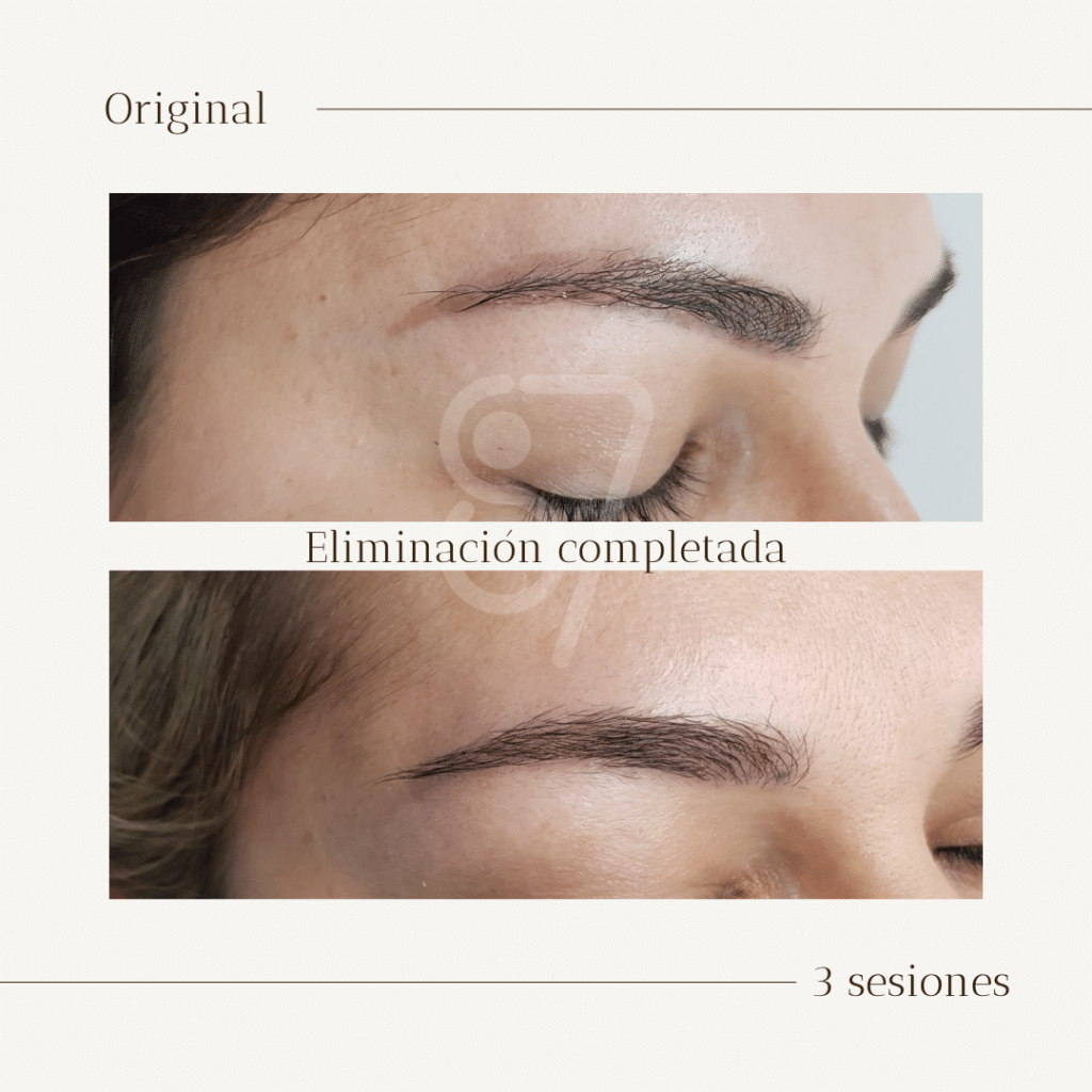 elominacion de micropigmentacion con laser