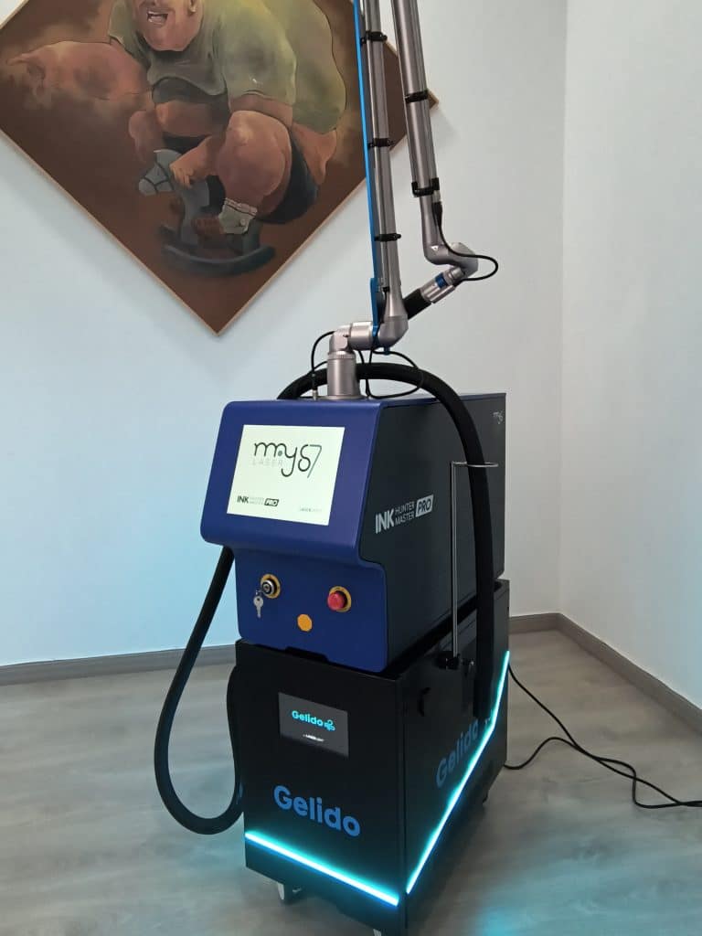 Equipo láser para eliminación de tatuajes en Granada